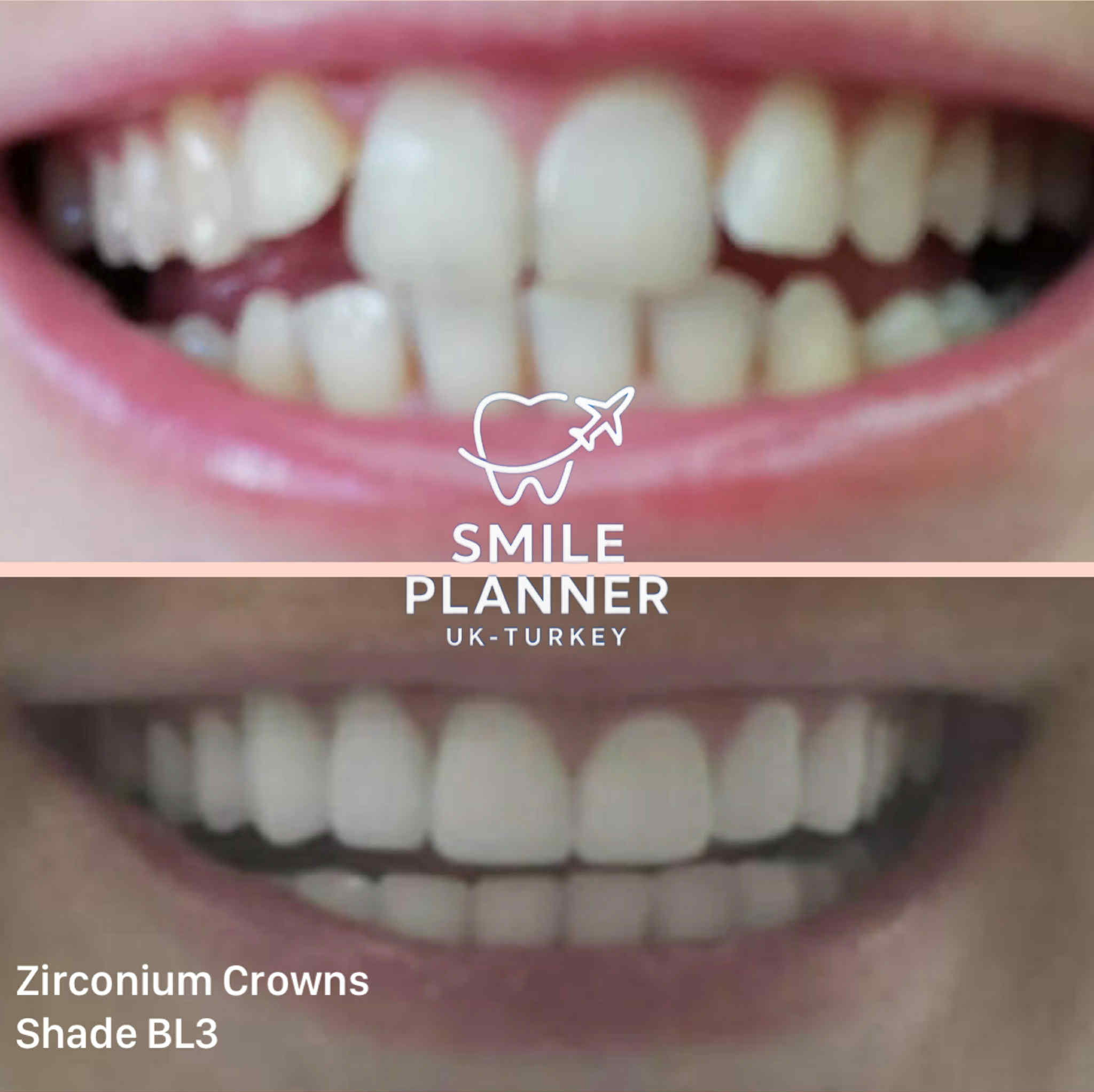 smile transformation zirconium crowns